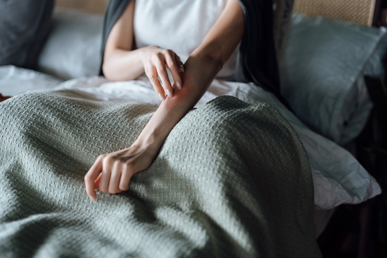 Woman with allergic reaction scratches arm
